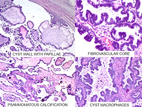 Histopathological Features Of Serous Cystadenoma Of The Ovary Showing