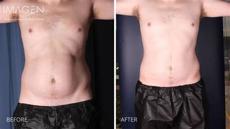 Mens Liposuction Omaha Liposuction By Imagen