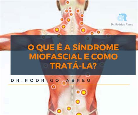 O que é a síndrome miofascial e como tratá la Aprenda Dr Rodrigo