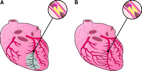 Assessment Of The Human Coronary Collateral Circulation Circulation