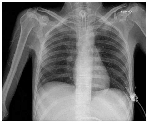 Chest X Ray Interpretation Detecting Devices And Device Related