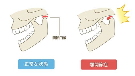 顎関節症はマウスピース矯正で治るの？悪化するの？原因とともに解説します！ アットスマイル矯正