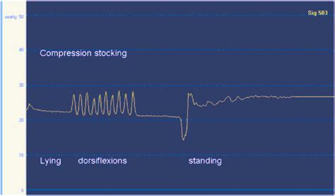 Pressure under a compression stocking, pressure range 20–30 mmHg ...