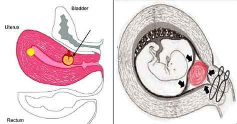 Diagnostics Free Full Text Successful Full Term Delivery Via