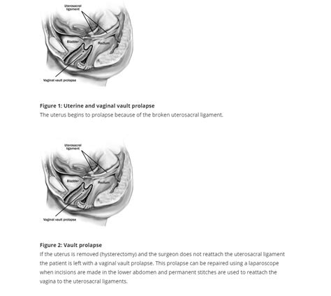 Laparoscopic Vault Suspension Women S Health Centre Gold Coast