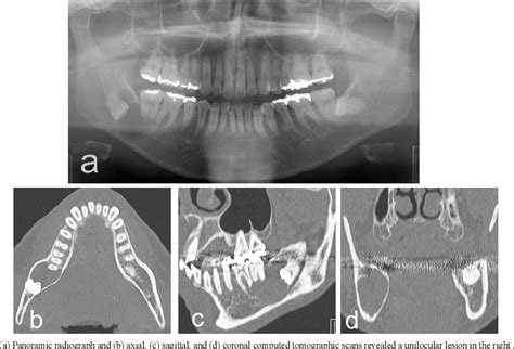 Figure From Glandular Odontogenic Cyst A Case Report And