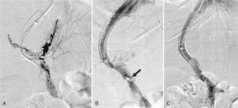 transjugular intrahepatic portosystemic shunting indications