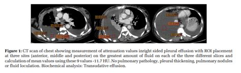 Diagnostic Accuracy Of Ct Hounsfield Unit In Distinguishing Exudative And Transudative Pleural