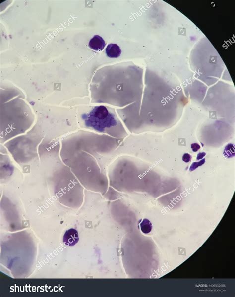 Russell Bodies Eosinophilic Large Homogeneous Immunoglobulin-containing ...