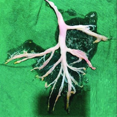 Bronchial cast showing coagulated fibrin and mucin with trapped mixed... | Download Scientific ...