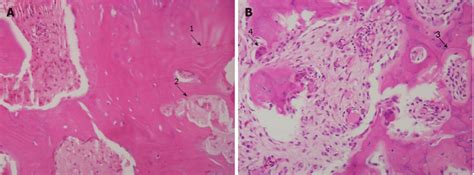 Histopathological Features Of Paget S Disease Of Bone A Biopsy