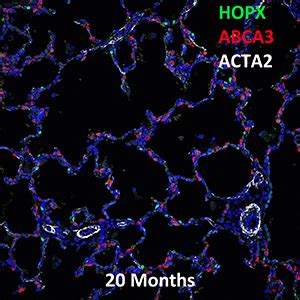 20 Month Human HOPX ABCA3 And ACTA2 Confocal Imaging