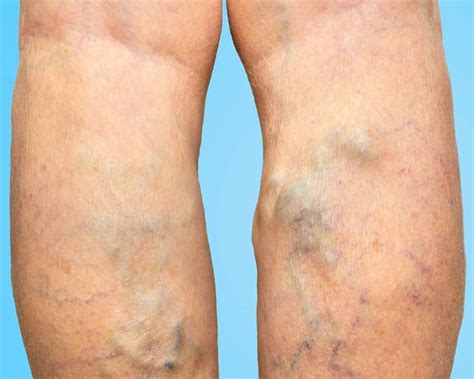 Varicose And Thread Veins Everything You Need To Know Simply Clinics