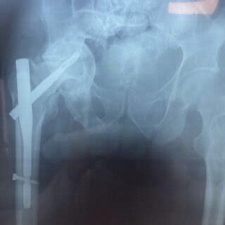 Post-operative anteroposterior radiograph showing pertrochanteric ...