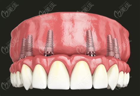 国产种植牙多少钱一颗？请看2023年国产种植牙价格表 美佳社区