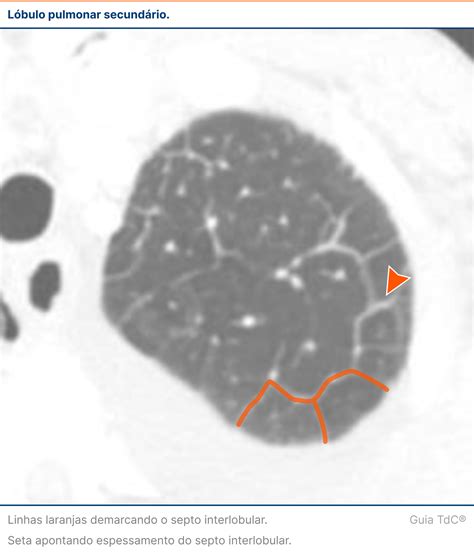 Espessamento Endometrial Cid 1