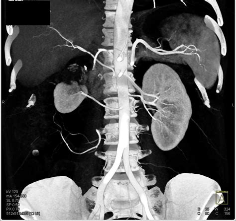 Scarring Upper Pole Right Kidney Kidney Case Studies Ctisus Ct Scanning