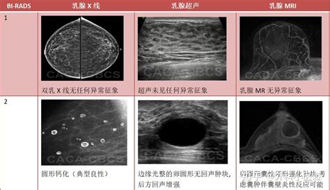 乳腺钼靶检查和乳腺彩超哪一个更准确？ 知乎