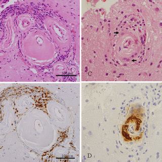 Neuropathological Findings Of The Biopsy Specimen From The Right