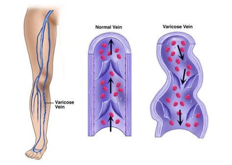 Vene Varicose Degli Arti Inferiori ANGIOCOR