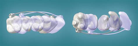 Motion Appliance Placement Fig2 Henry Schein Dental Orthodontics