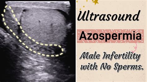 Scrotal Ultrasound Azoospermia Typecauses Male Infertility With