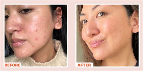 Radiofrequency Microneedling For Acne Scars Before And After