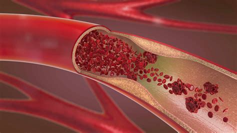 Arteriosclerosis: Overview and More