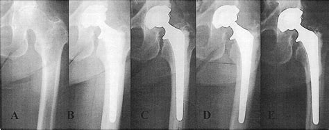 Elective Primary Total Hip Arthroplasty In Octogenarians A Download Scientific Diagram