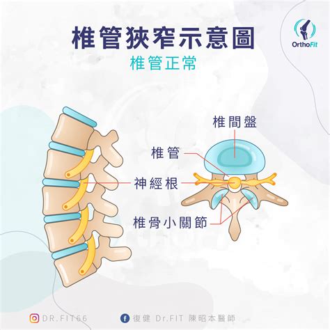 椎管狹窄 Orthofit陳昭本醫師