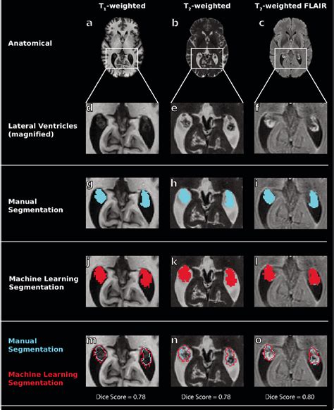 Table 1 From Deep Learning Segmentation Of The Choroid Plexus From