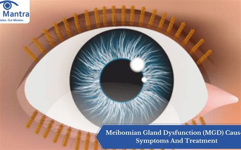 Meibomian Gland Dysfunction (MGD) Causes, Symptoms And Treatment