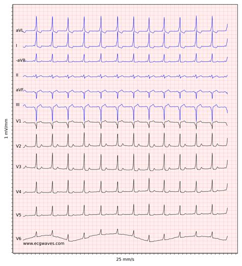 Pre-excitation, Atrioventricular Reentrant (Reentry) Tachycardia (AVRT ...