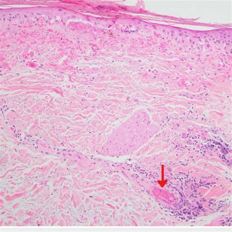 Punch Biopsy Of The Resolving Lesion Hande ×40 Download Scientific