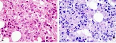 Histoplasma capsulatum: Properties, Diseases, Lab Diagnosis • Microbe ...