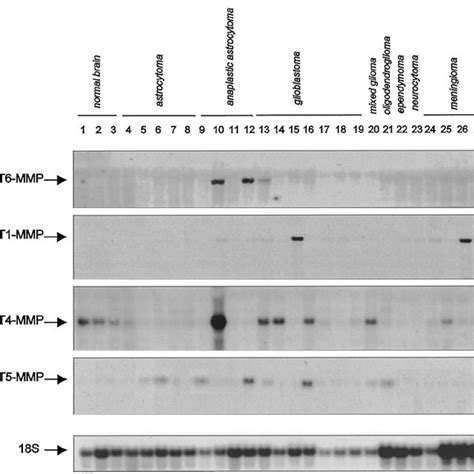 Northern Blot Analysis Of MT6 MMP Expression In Brain Tumors About 10