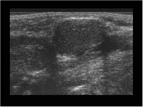 Ranula Ultrasound