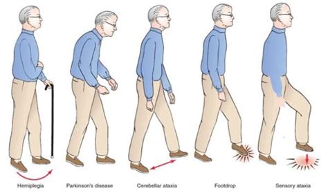 Gait Analysis Indian Association Of Chartered Physiotherapists