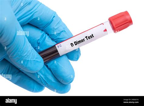 D Dimer Test Medical check up test tube with biological sample Stock ...