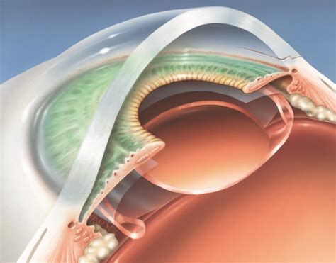 Cataract Surgery What Does It Involve Resuscitate Hospital