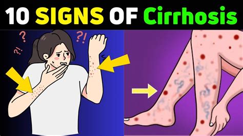 Top 10 Early Signs Of Liver Cirrhosis Youtube