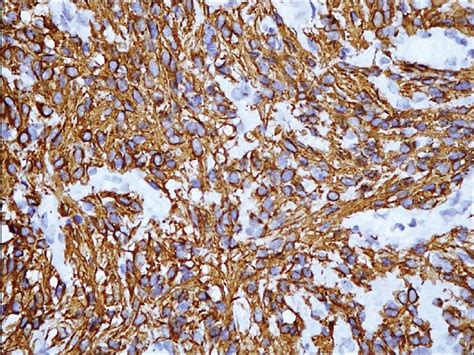 The Tumor Cells Are Diffusely Positive For Gfap Immunostain