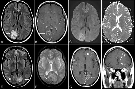 Autoimmune Encephalitis Pathophysiology And Imaging Review Of An