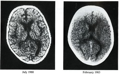 Reversible Brain Shrinkage Documented By Computerized Tomography