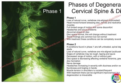 Cervical Spinal Degeneration Phases Poster – Body of Elements