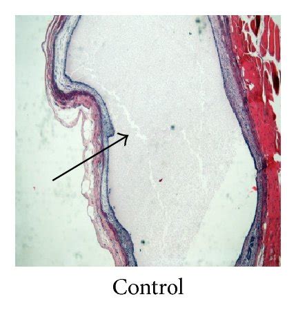 Morphological changes in ectopic endometrium after KTC treatment for 21 ... 