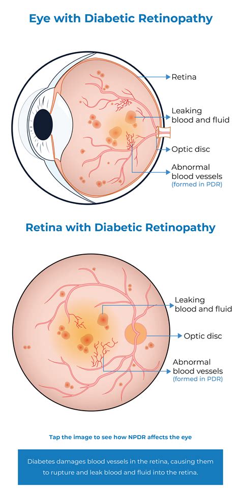 DR - Diabetic Retinopathy - Kodiak Sciences