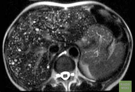 Biliary Hamartomas In The Liver Radrounds Radiology Network