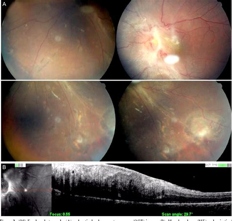 Pdf A Case Report Of Primary Vitrectomy In Multiple Bilateral Retinal Capillary Hemangiomas