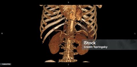 Ct Tubuh 3d Pencitraan Medis Radiologi Perut Resolusi Tinggi Menghitung